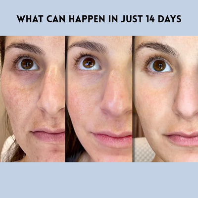 JugendLifting™ Sofortiges Jugendliches Lifting